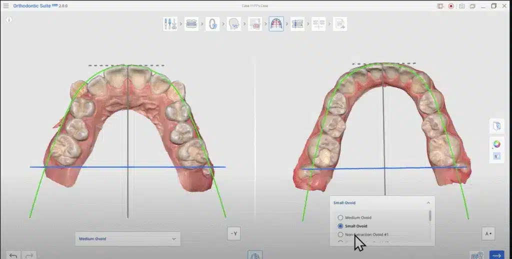 Split-screen 3D view of an upper dental arch in orthodontic software, with green tooth outlines and blue alignment lines.