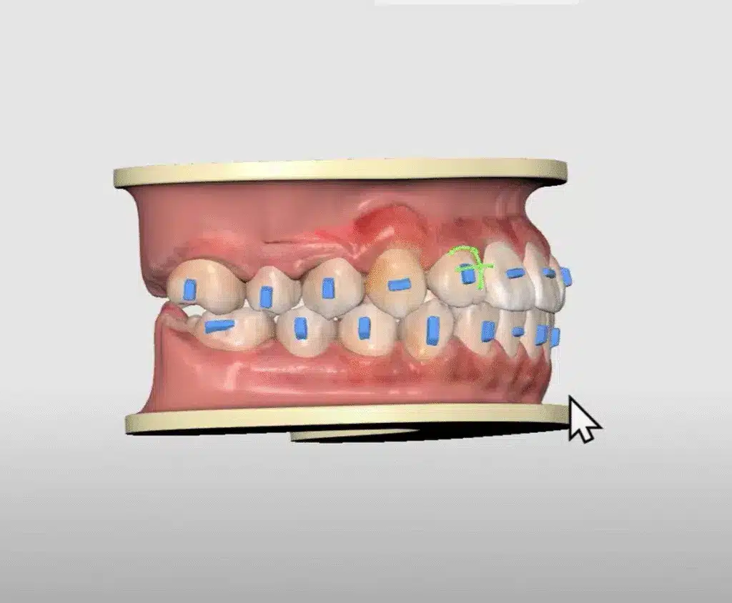 3D dental model of upper and lower teeth with braces (blue brackets) being adjusted, cursor pointing at the bite.