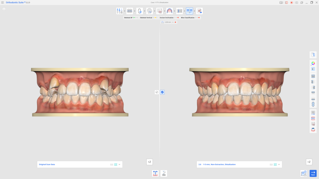 Side-by-side 3D dental models comparing crowded left bite with improved alignment on the right, for orthodontic planning.