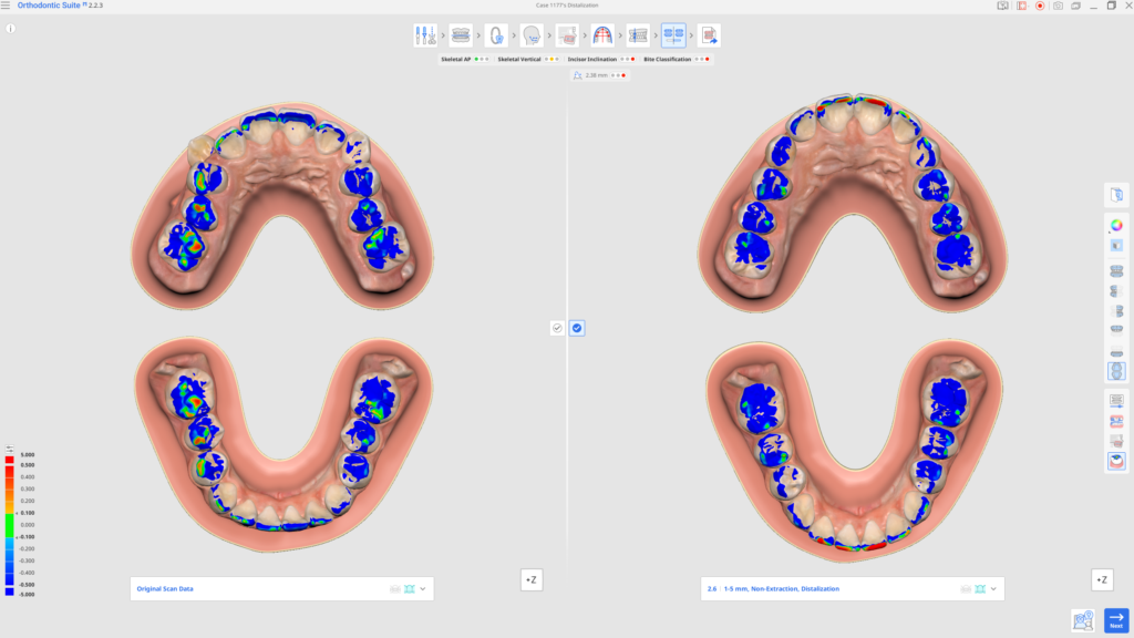 Two 3D intraoral scans side by side showing upper and lower dental arches with a color‑coded occlusal contact map (blue to red indicating contact intensity) for orthodontic assessment