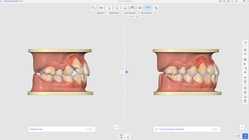 Side-by-side 3D views of a patient’s jaws in orthodontic software, showing upper and lower arches (left pre-treatment, right post-treatment)
