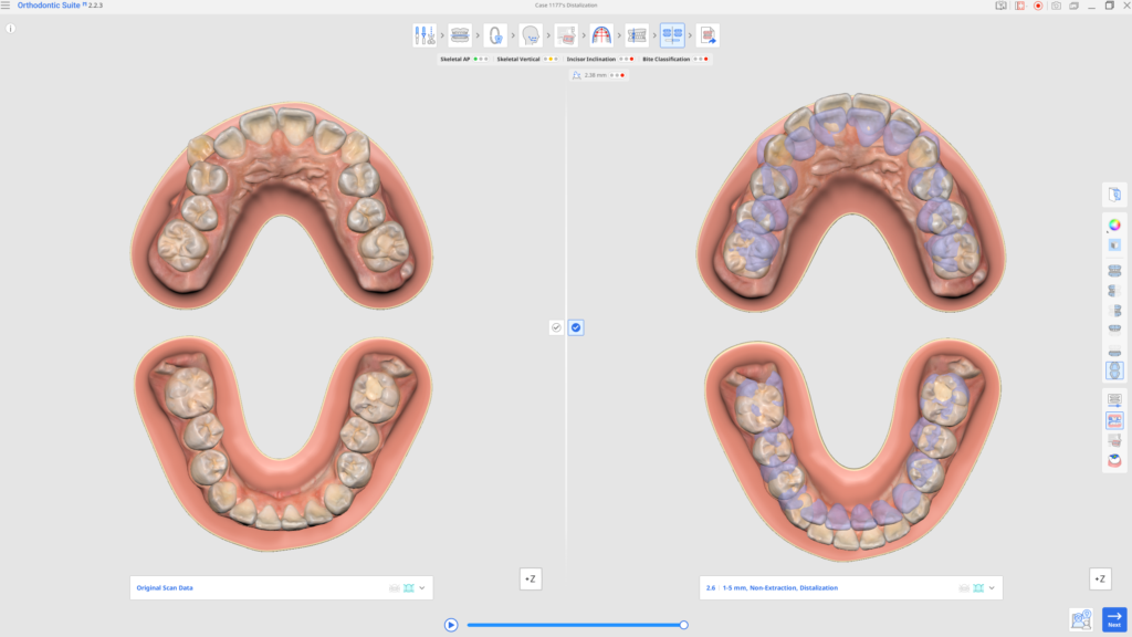 Split-screen orthodontic 3D model: left shows the upper jaw before treatment; right shows the planned tooth movements with purple overlays indicating adjustments.