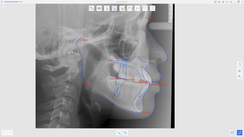 Cephalometric X-ray with blue tracing and red labeled landmarks (Sella, Nasion, Condylion, A, B, molars, Gnathion).