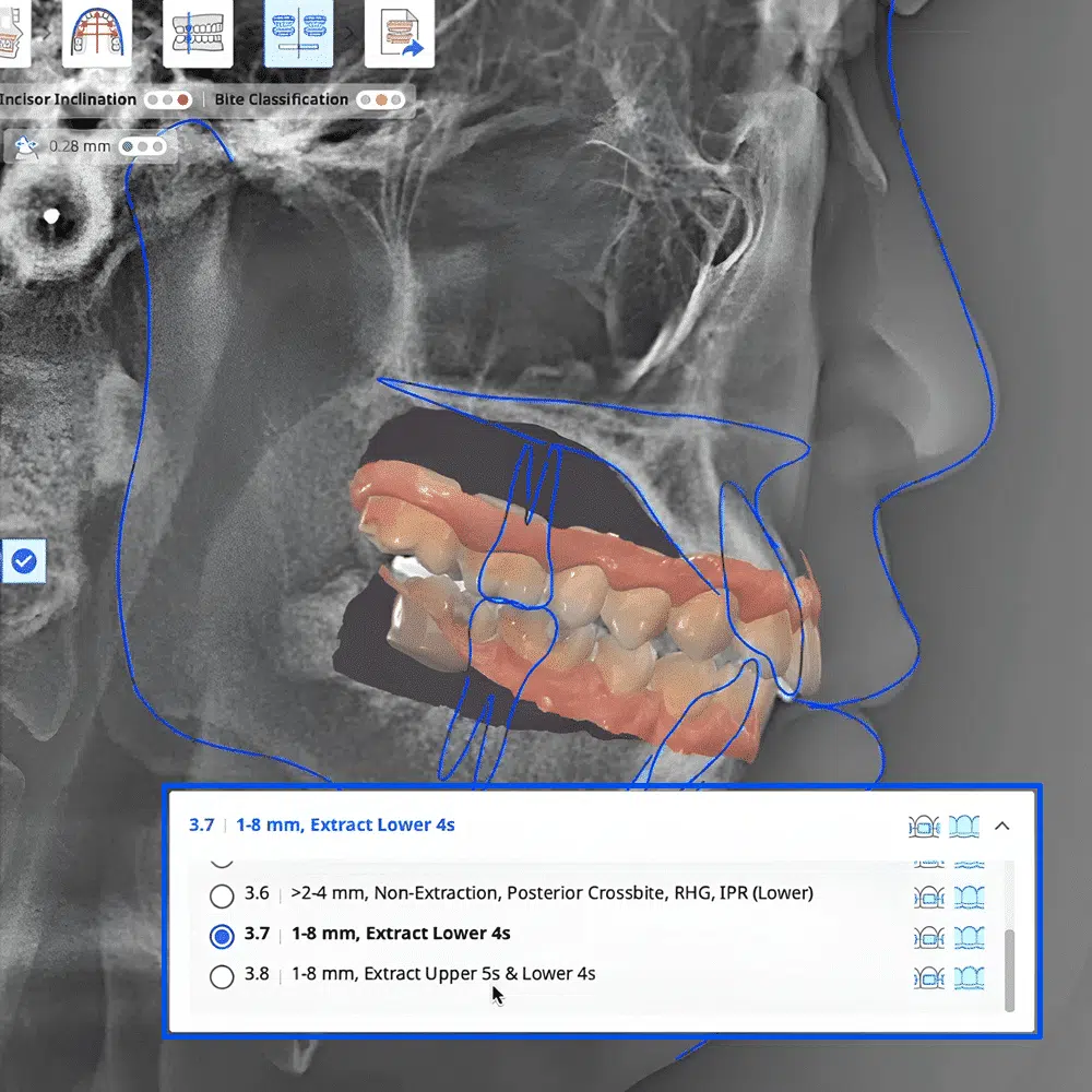 Dental CBCT image with blue contour lines around the jaw and a lower dental model; on-screen options show extraction plan for lower teeth (e.g., 1–8 mm, Extract Lower 4s)