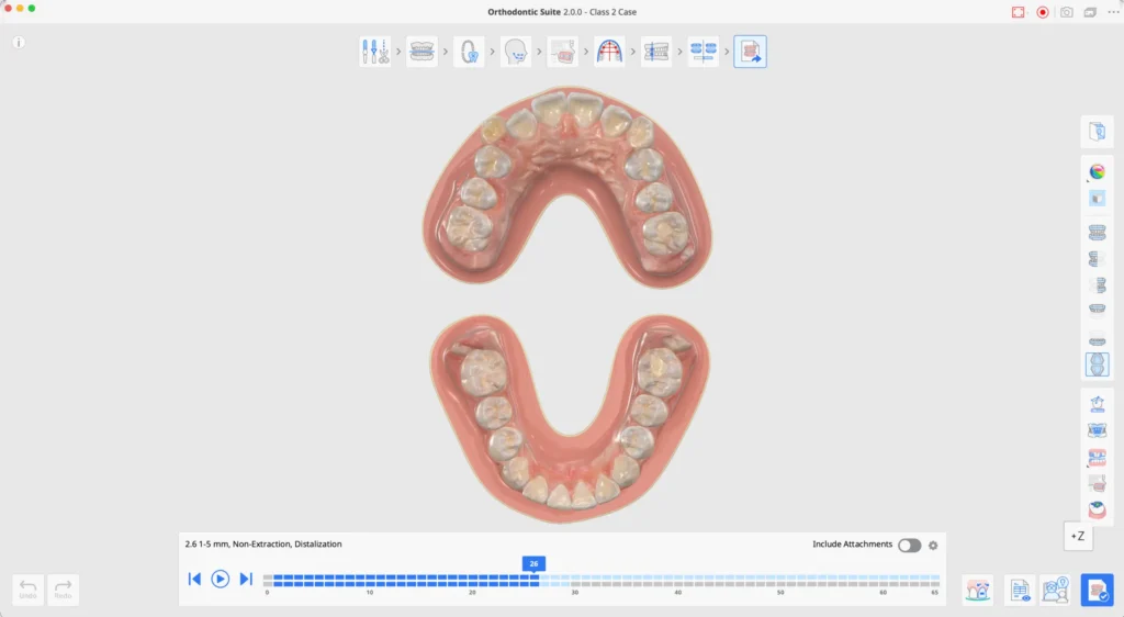 3D model of upper and lower dental arches with teeth and gums for orthodontic assessment